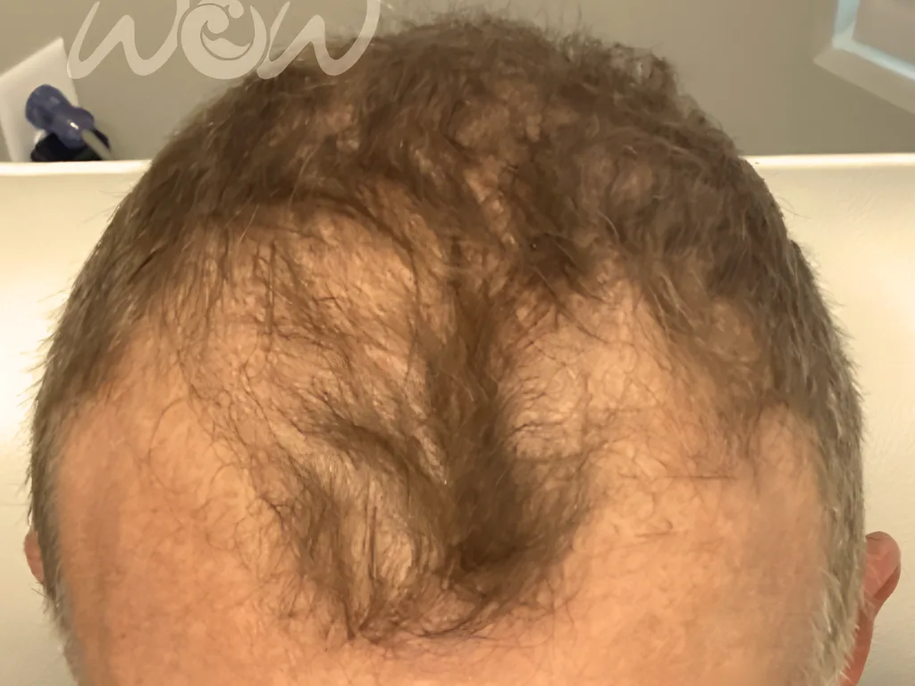 After Alma TED treatment — October 2024